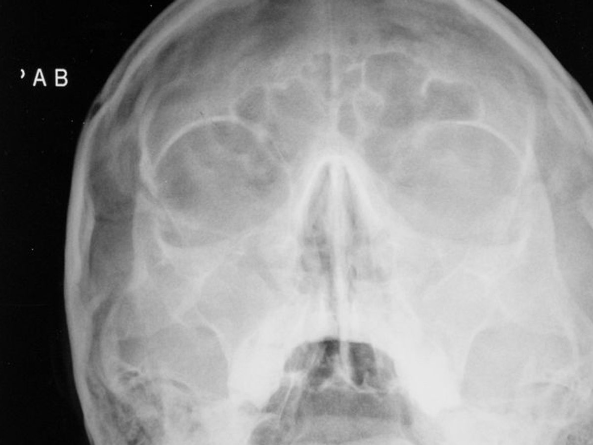 Cranio-Maxillofacial Implants