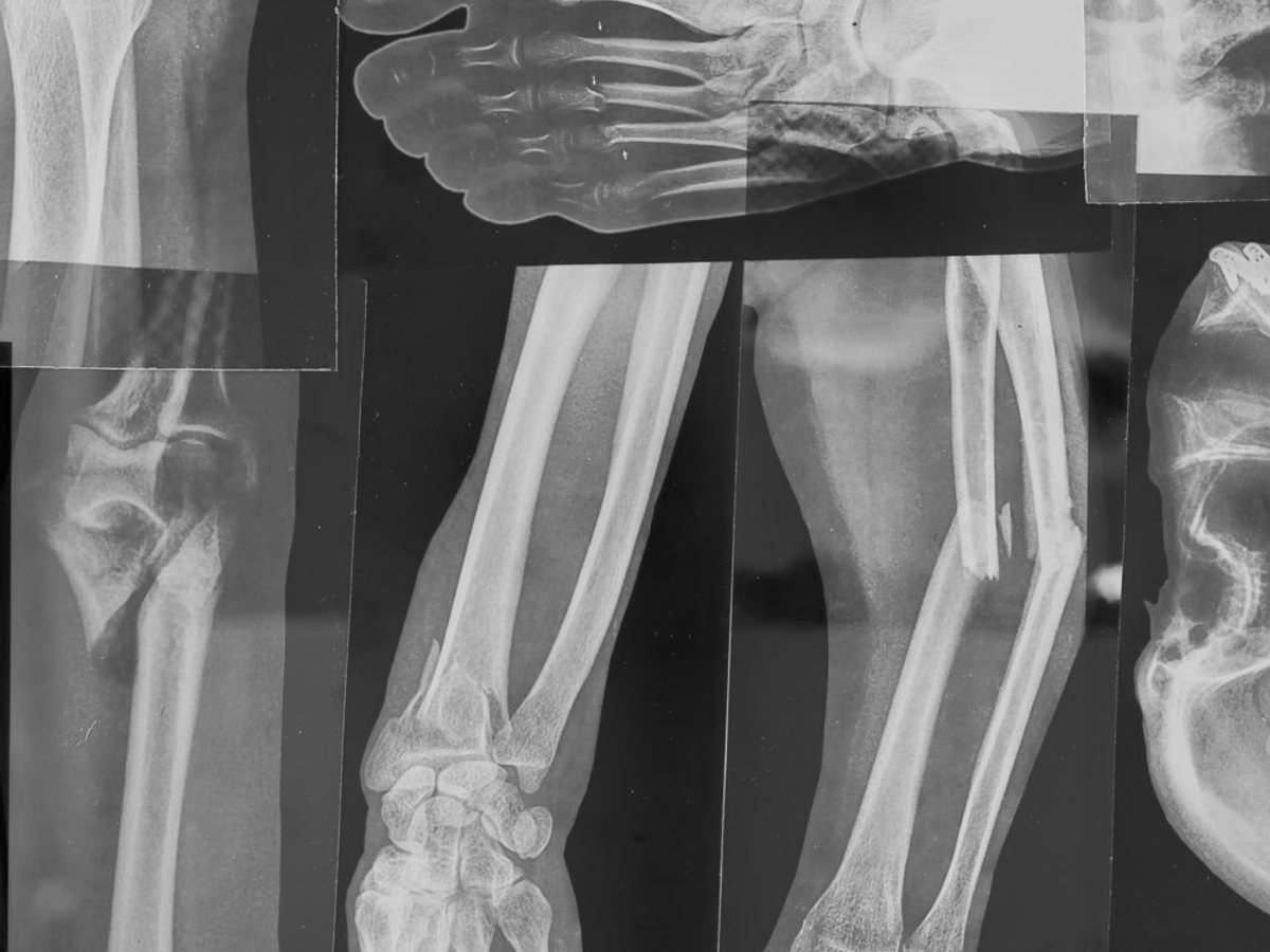 Osteosynthesis Implants